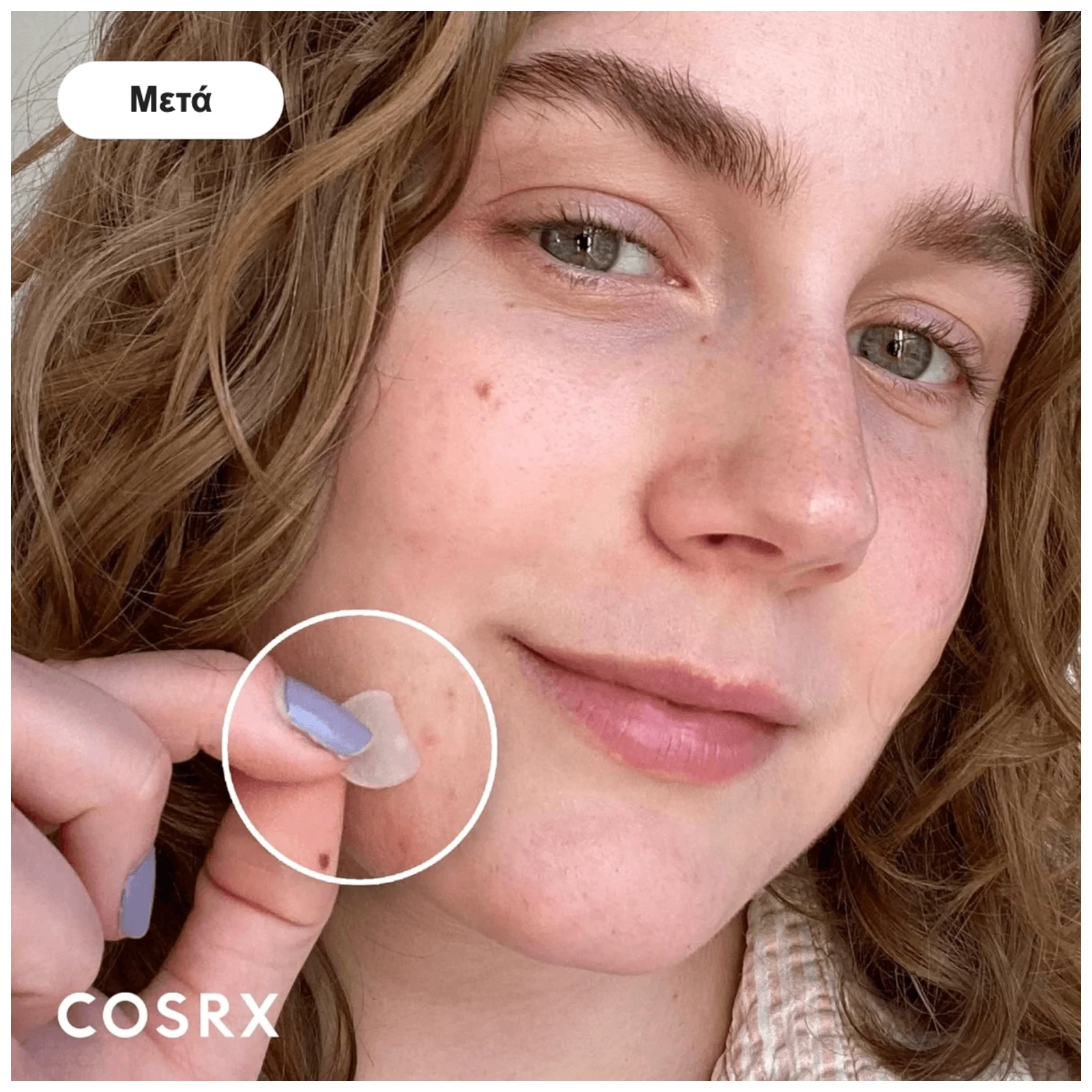 COSRX Acne Pimple Master Patch – μετά τη χρήση